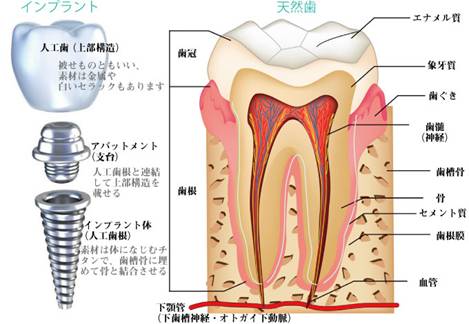 インプラント治療図