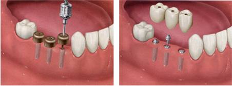 一回法（フラップ手術）画像