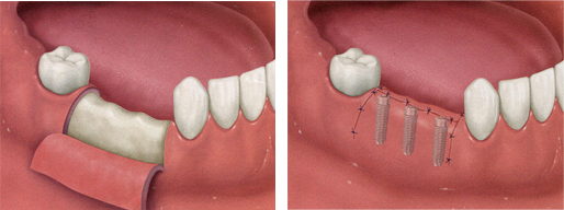無切開無痛手術（フラップレス）画像