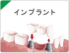 西宮市武庫川(むこがわ)鳴尾、小松北町にある歯医者 まつうら歯科クリニックのインプラント