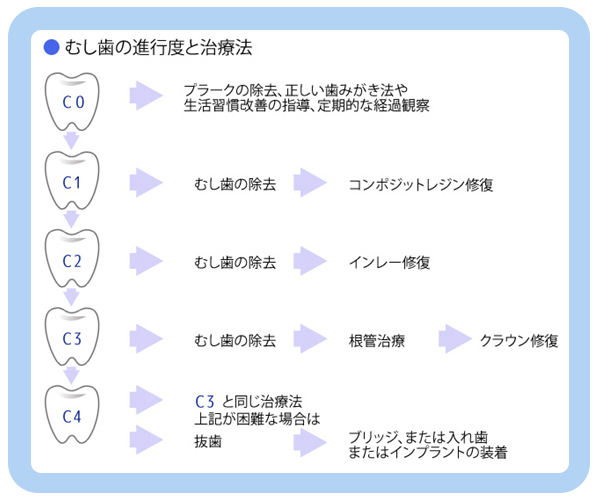 虫歯の進行度と治療法
