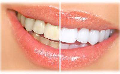 オフィスホワイトニング画像