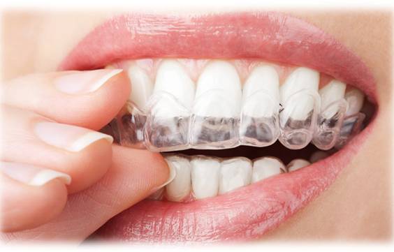 ホームホワイトニング画像