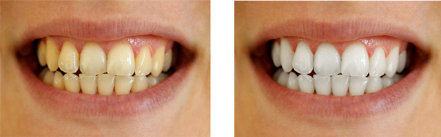 デュアルホワイトニング